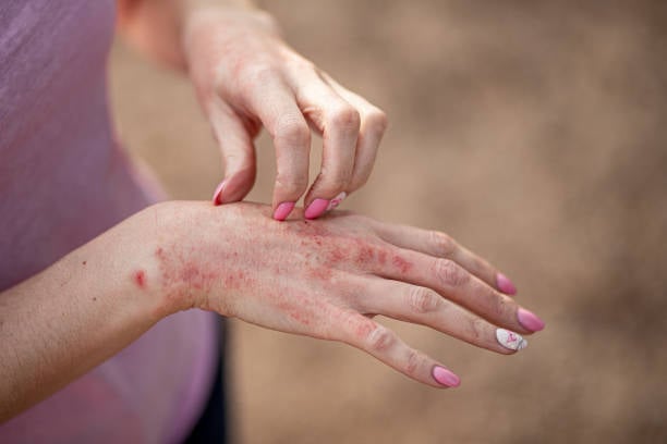 Productos Naturales para Tratar la Psoriasis: Consigue una Piel Radiante y Saludable
